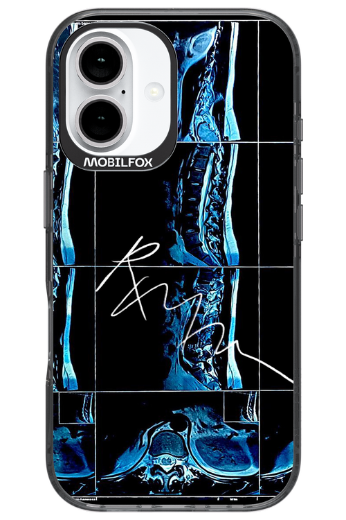 RMN Scolioza 2.0 - Apple iPhone 16