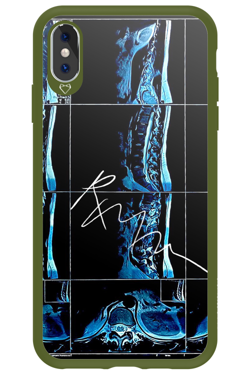 RMN Scolioza 2.0 - Apple iPhone XS Max