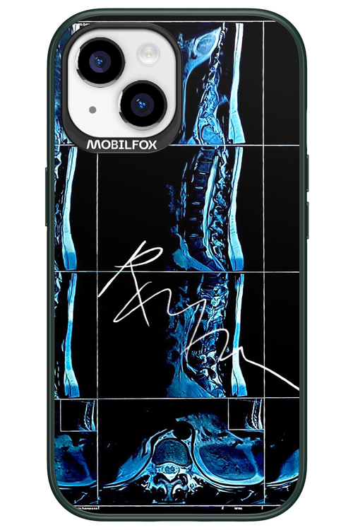 RMN Scolioza 2.0 - Apple iPhone 15