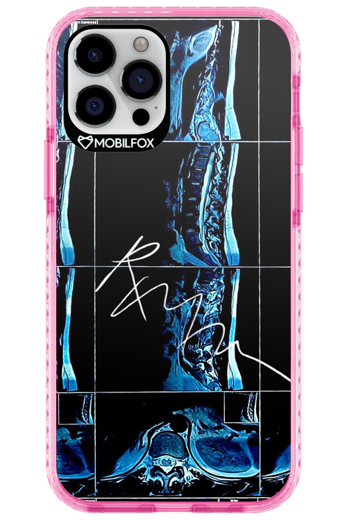 RMN Scolioza 2.0 - Apple iPhone 12 Pro