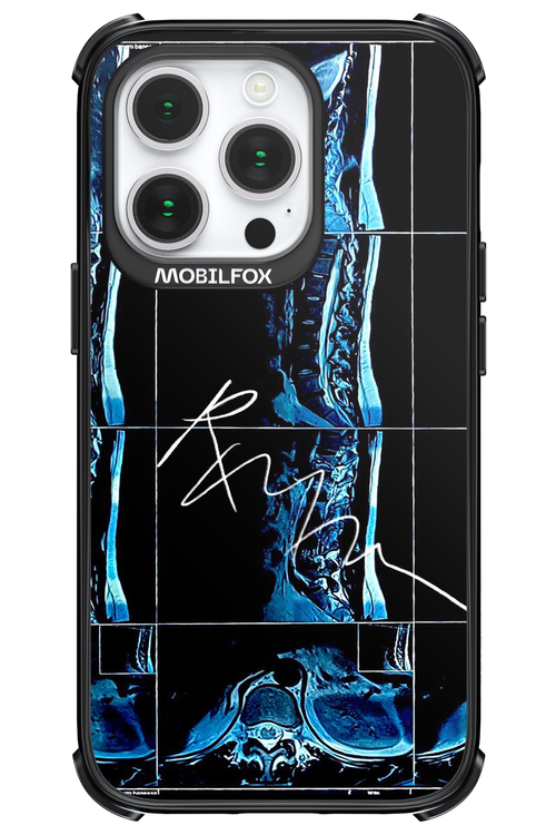 RMN Scolioza 2.0 - Apple iPhone 14 Pro