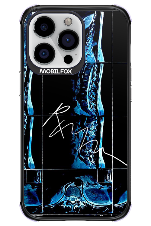 RMN Scolioza 2.0 - Apple iPhone 13 Pro
