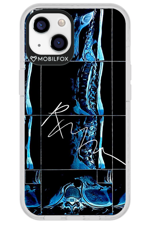 RMN Scolioza 2.0 - Apple iPhone 13