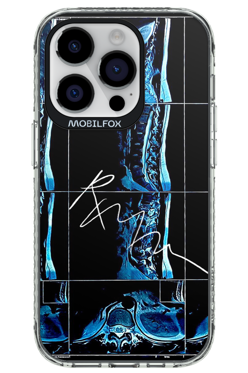 RMN Scolioza 2.0 - Apple iPhone 14 Pro