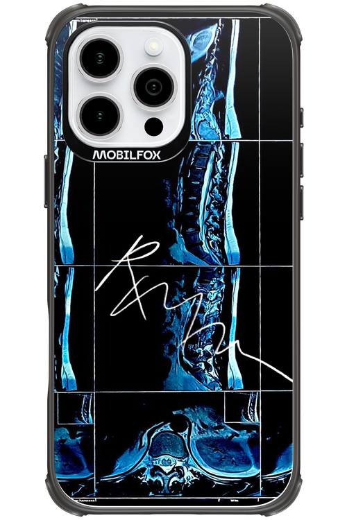 RMN Scolioza 2.0 - Apple iPhone 16 Pro Max