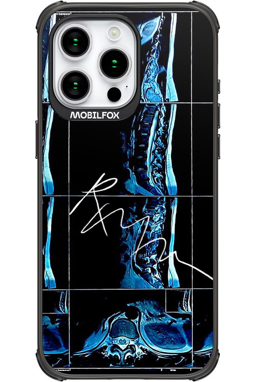 RMN Scolioza - Apple iPhone 15 Pro Max
