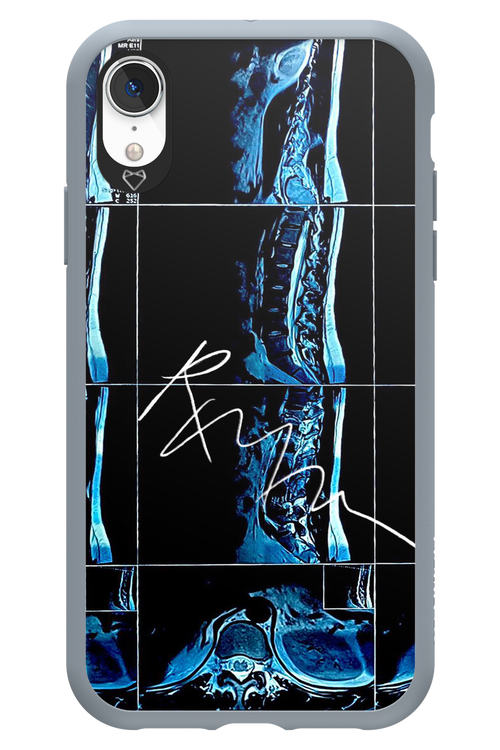 RMN Scolioza 2.0 - Apple iPhone XR