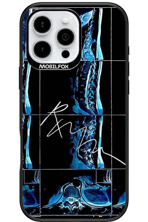 RMN Scolioza 2.0 - Apple iPhone 16 Pro Max