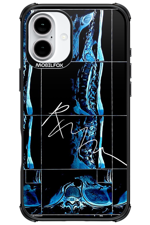 RMN Scolioza 2.0 - Apple iPhone 16 Plus
