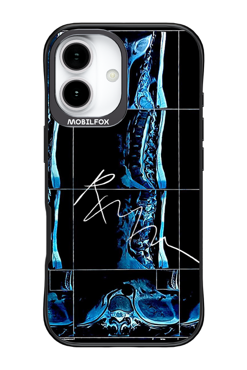 RMN Scolioza 2.0 - Apple iPhone 17
