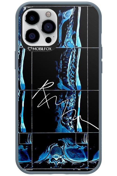 RMN Scolioza 2.0 - Apple iPhone 12 Pro Max
