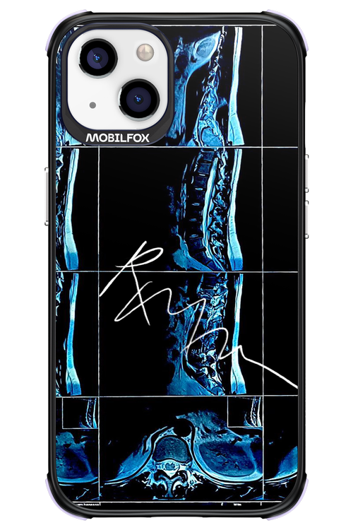 RMN Scolioza 2.0 - Apple iPhone 13