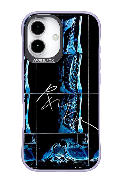 RMN Scolioza 2.0 - Apple iPhone 17