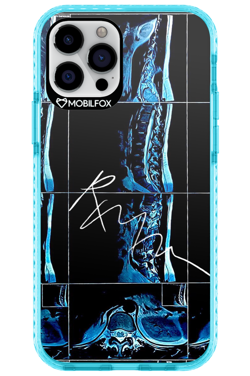 RMN Scolioza 2.0 - Apple iPhone 12 Pro