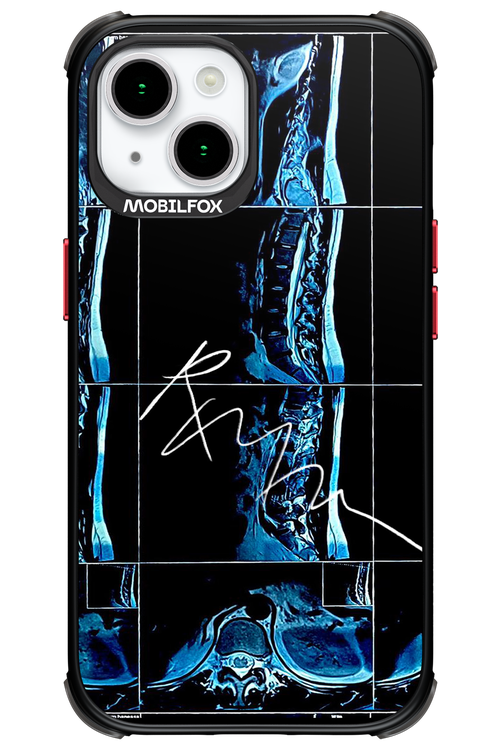 RMN Scolioza 2.0 - Apple iPhone 15