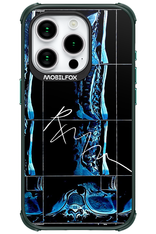 RMN Scolioza - Apple iPhone 15 Pro