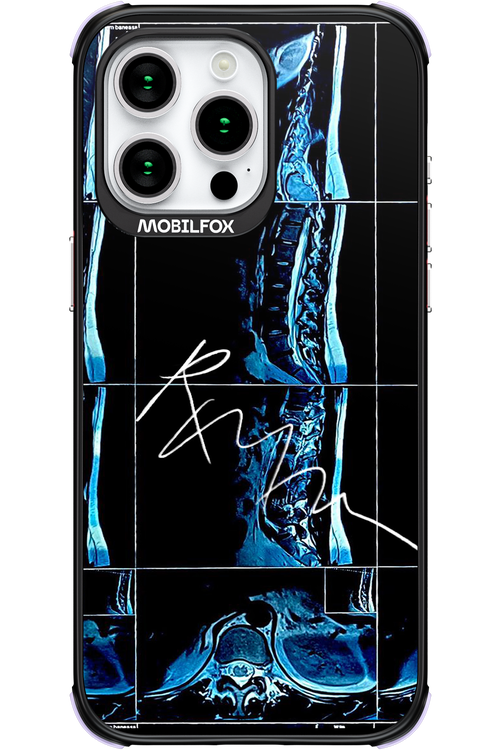 RMN Scolioza - Apple iPhone 15 Pro Max