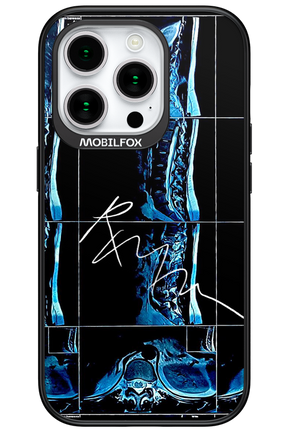RMN Scolioza 2.0 - Apple iPhone 15 Pro