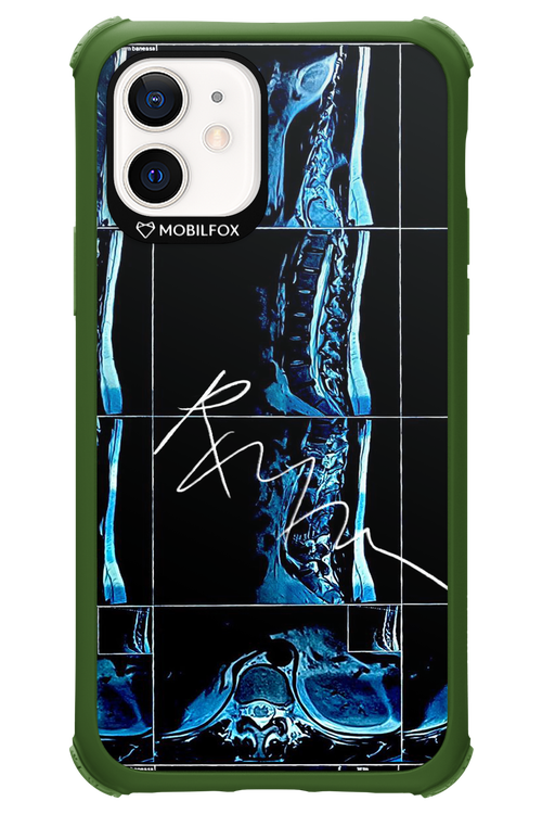 RMN Scolioza 2.0 - Apple iPhone 12