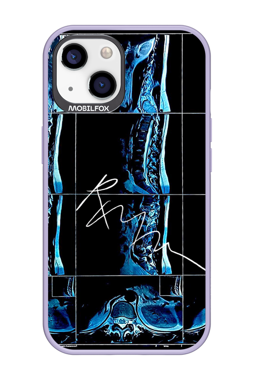 RMN Scolioza 2.0 - Apple iPhone 13