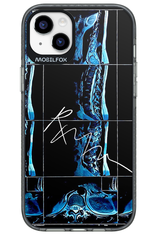 RMN Scolioza 2.0 - Apple iPhone 14 Plus