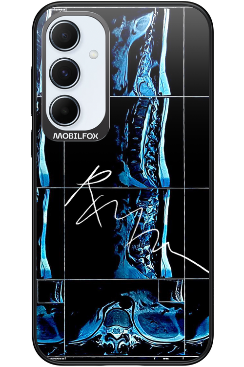 RMN Scolioza 2.0 - Samsung Galaxy A55