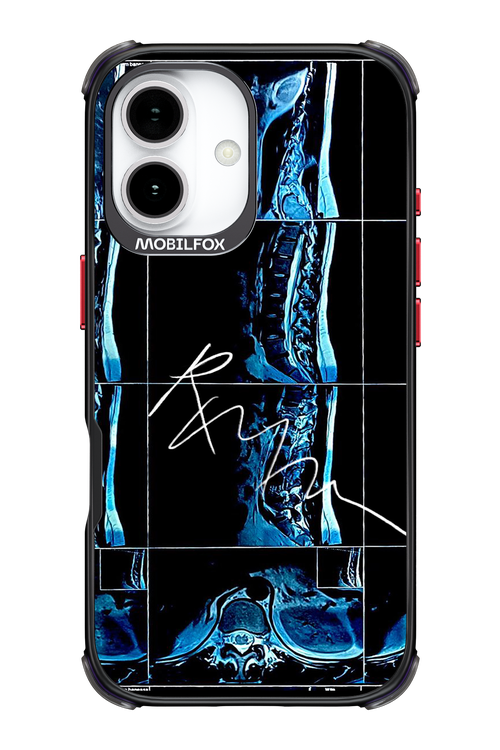 RMN Scolioza 2.0 - Apple iPhone 17