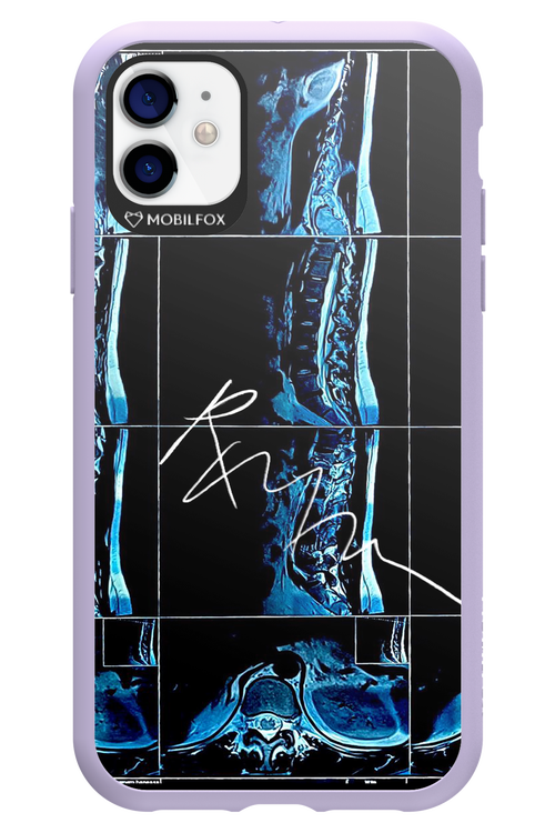 RMN Scolioza 2.0 - Apple iPhone 11