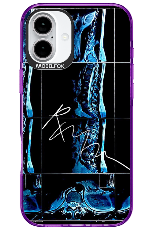 RMN Scolioza 2.0 - Apple iPhone 16 Plus