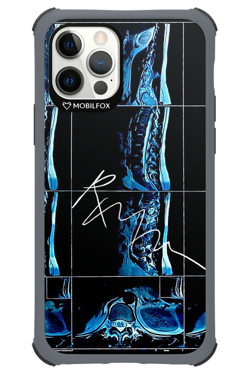 RMN Scolioza 2.0 - Apple iPhone 12 Pro