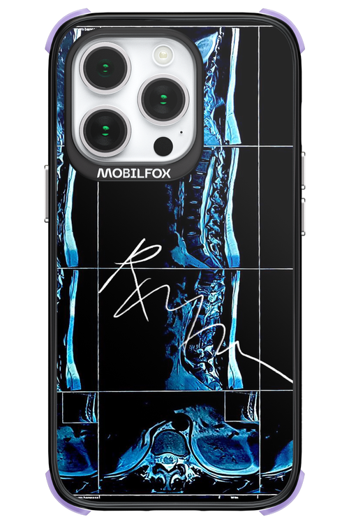 RMN Scolioza 2.0 - Apple iPhone 14 Pro
