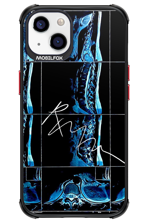 RMN Scolioza 2.0 - Apple iPhone 13