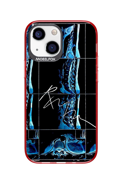 RMN Scolioza 2.0 - Apple iPhone 13 Mini