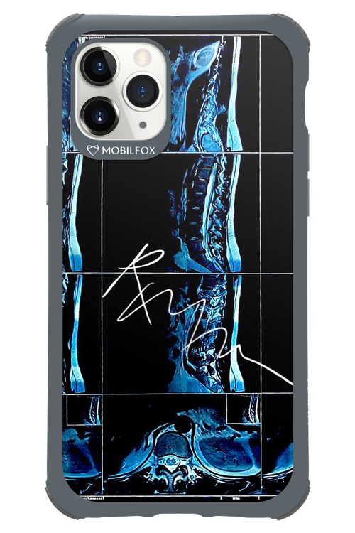 RMN Scolioza 2.0 - Apple iPhone 11 Pro