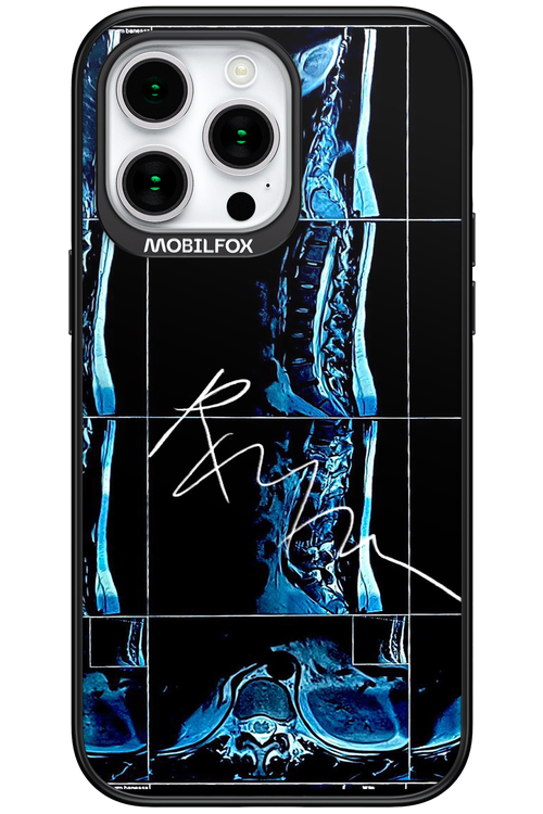 RMN Scolioza - Apple iPhone 15 Pro Max