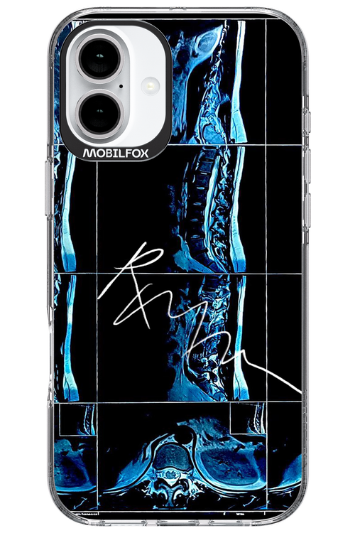 RMN Scolioza 2.0 - Apple iPhone 16 Plus