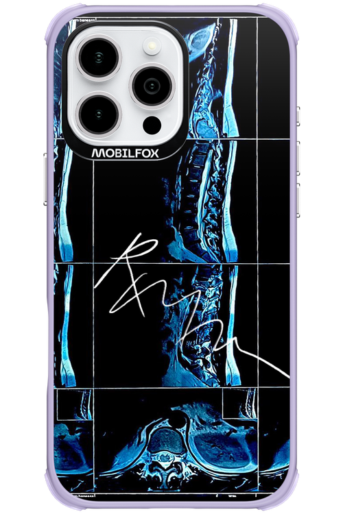 RMN Scolioza 2.0 - Apple iPhone 16 Pro Max