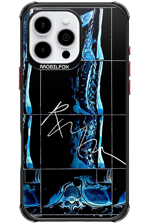 RMN Scolioza 2.0 - Apple iPhone 16 Pro Max