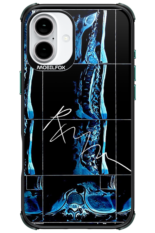 RMN Scolioza 2.0 - Apple iPhone 16 Plus