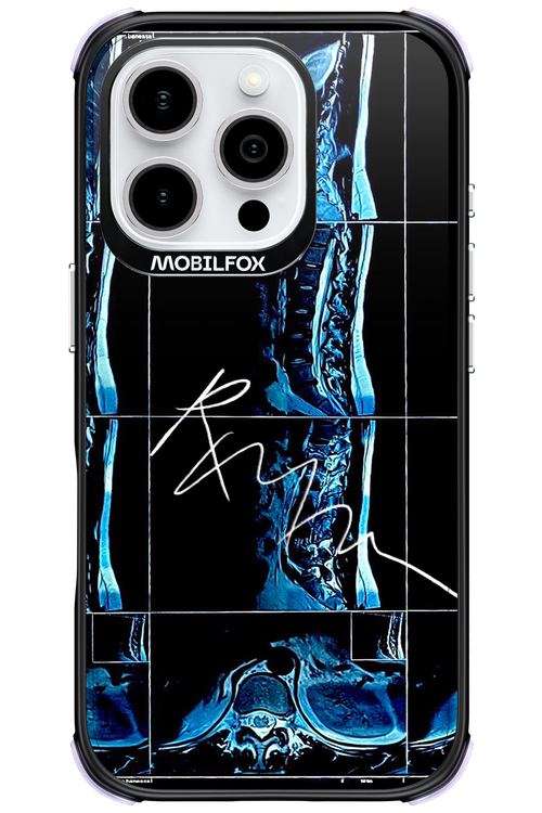 RMN Scolioza - Apple iPhone 16 Pro