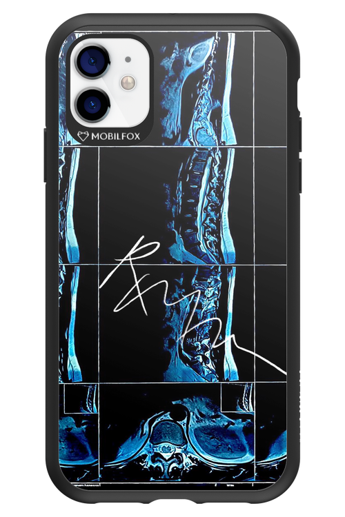 RMN Scolioza 2.0 - Apple iPhone 11