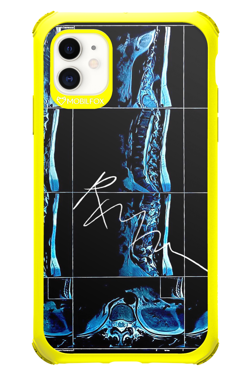 RMN Scolioza 2.0 - Apple iPhone 11