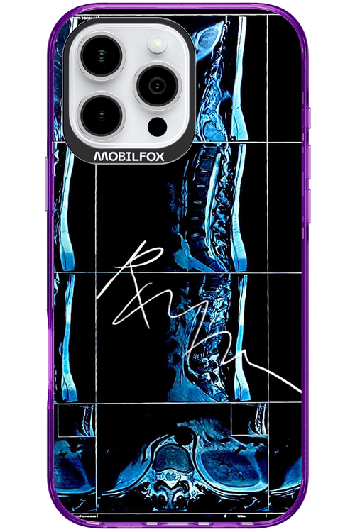 RMN Scolioza 2.0 - Apple iPhone 16 Pro Max