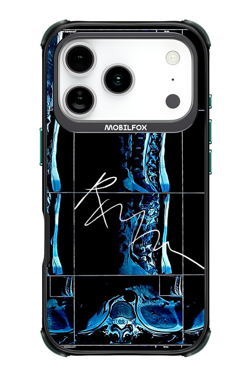 RMN Scolioza 2.0 - Apple iPhone 17 Pro