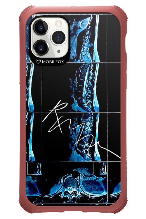 RMN Scolioza 2.0 - Apple iPhone 11 Pro