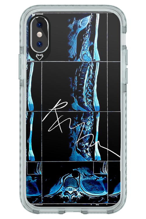 RMN Scolioza 2.0 - Apple iPhone XS