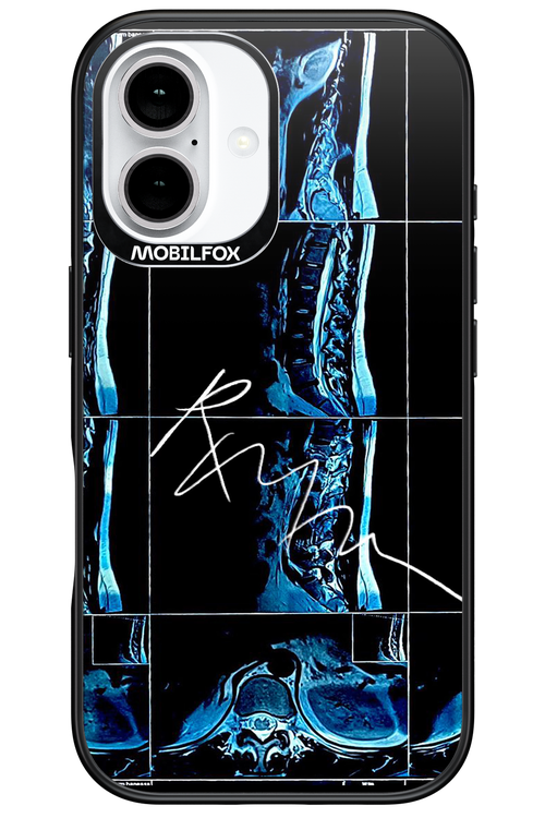 RMN Scolioza 2.0 - Apple iPhone 16