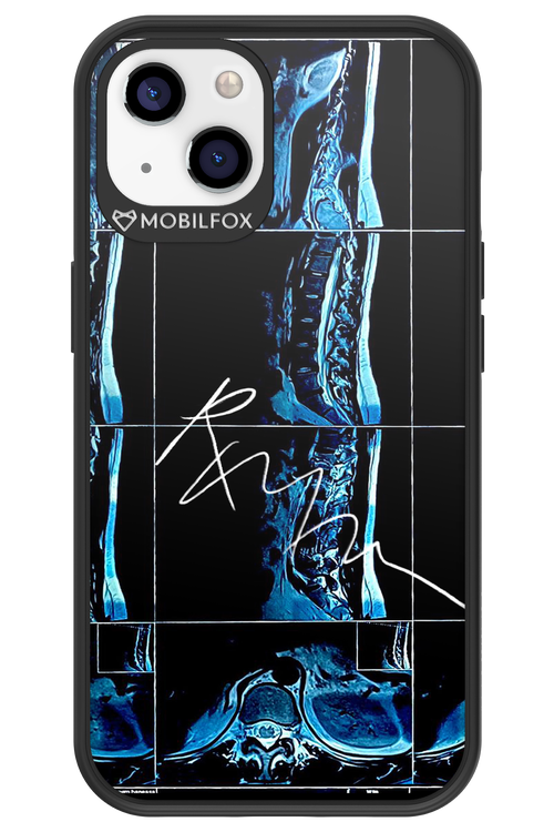 RMN Scolioza 2.0 - Apple iPhone 13