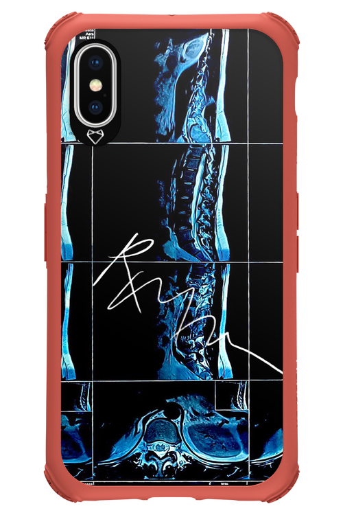 RMN Scolioza 2.0 - Apple iPhone XS