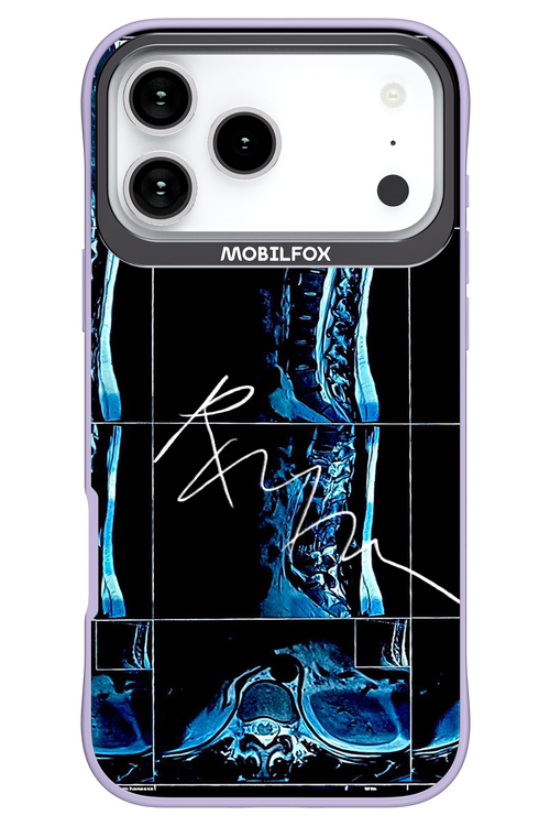 RMN Scolioza 2.0 - Apple iPhone 17 Pro Max
